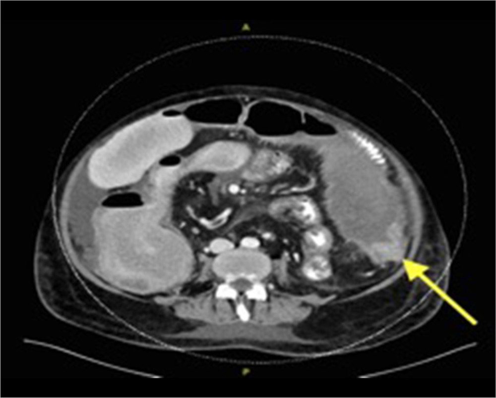 Computed tomography of the abdomen showing a splenic flexure colon mass (yellow arrow).
