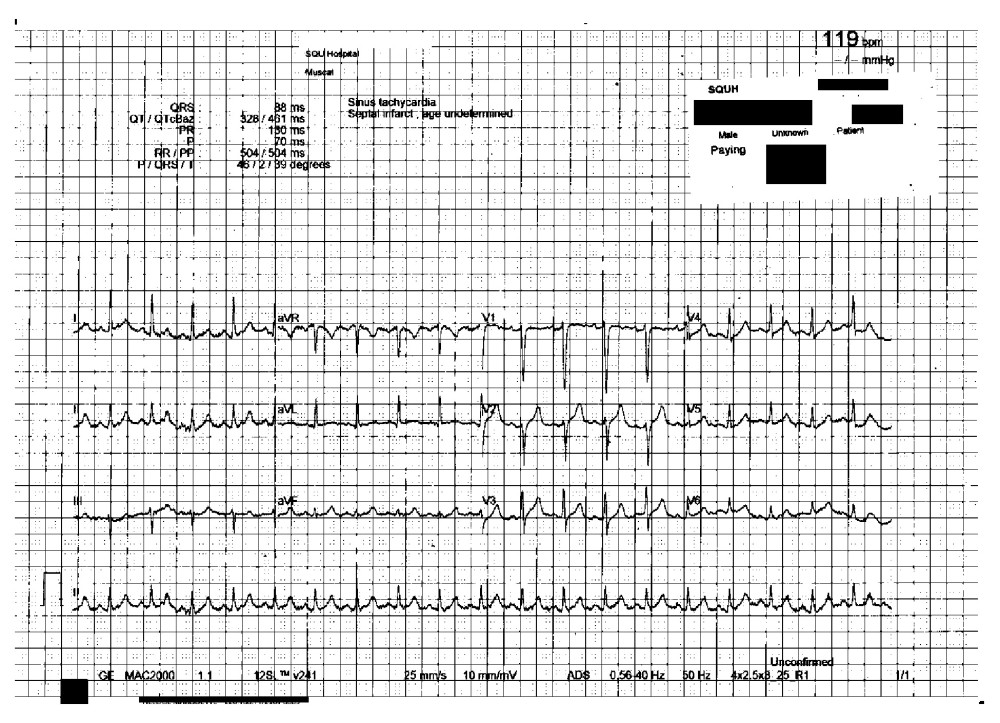 Twelve-lead electrocardiography obtained on the day of presentation.