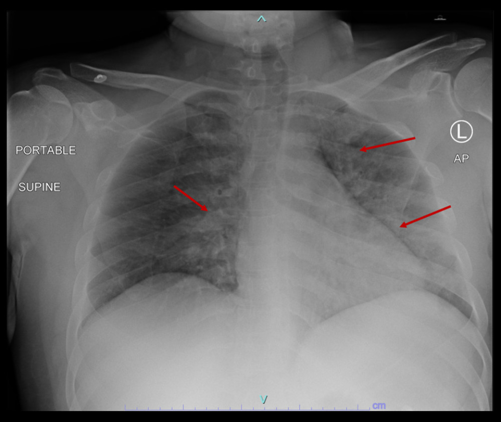Chest X-ray on day of presentation showing extensive bilateral pulmonary infiltrates (red arrows).