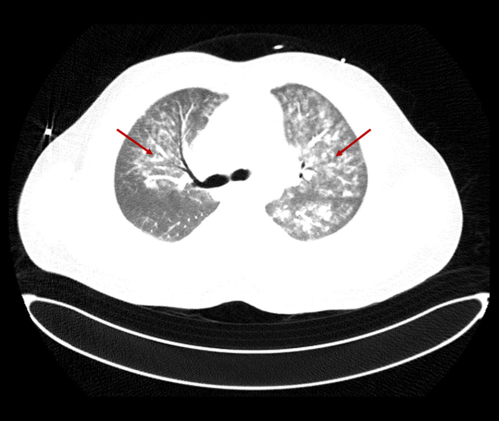 Chest computed tomography with contrast showing extensive bilateral ground-glass and patchy nodular opacities, more on the left lung (red arrows).