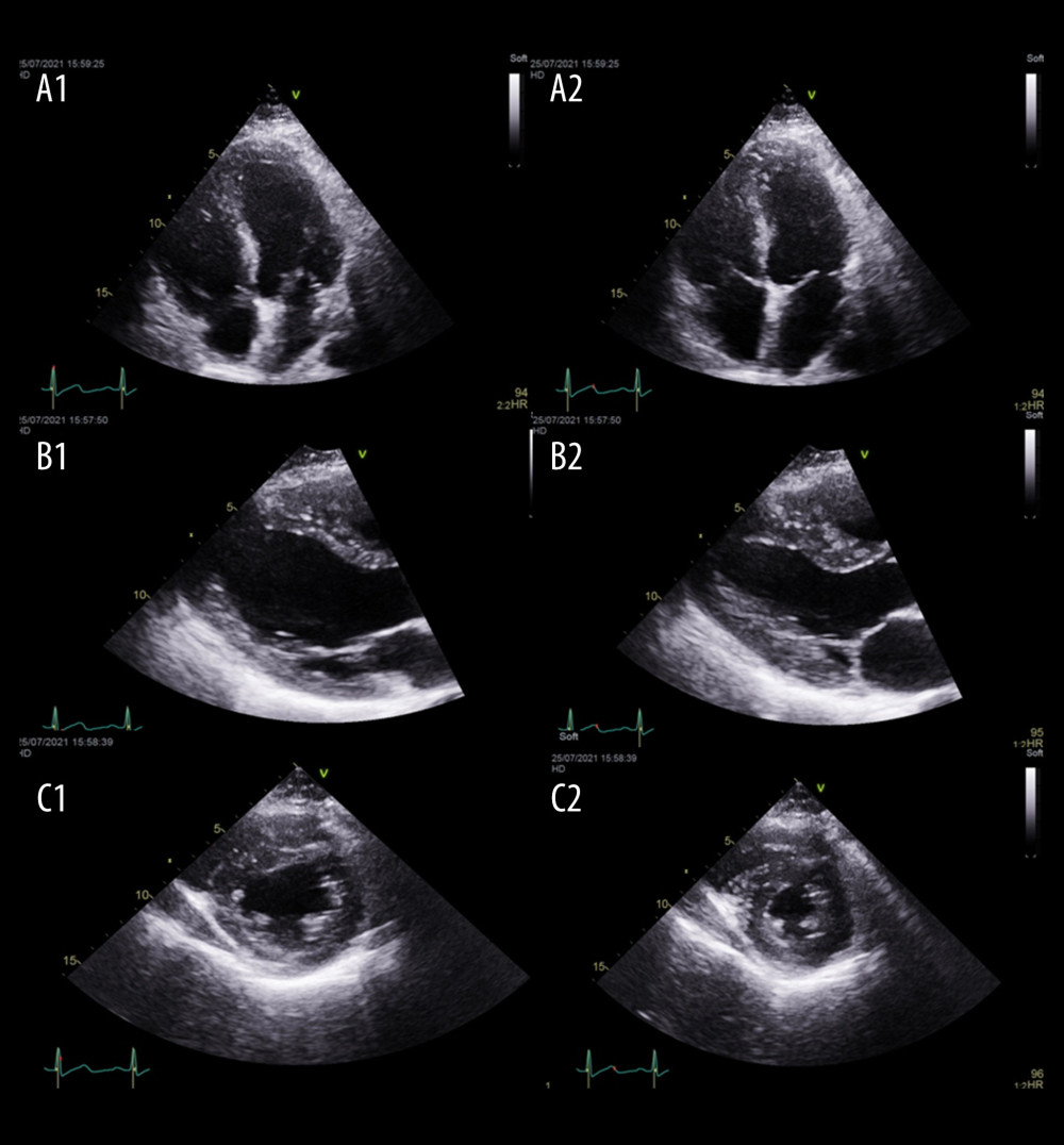 Echocardiogram at presentation demonstrating the following views: (A1) 4-chamber view in diastole; (A2) 4-chamber view in systole; (B1) parasternal long-axis view in diastole; (B2) parasternal long-axis view in systole; (C1) parasternal short axis view in diastole; and (C2) parasternal short axis view in systole.