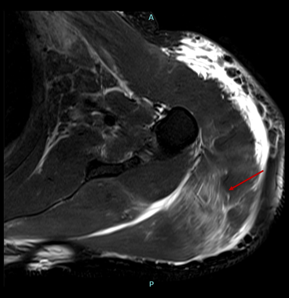 Magnetic resonance imaging T2 fat-suppressed axial sequence of the left shoulder with diffuse subcutaneous edema and abnormal signal intensity of deltoid muscle, infraspinatus, and supraspinatus muscles, likely representing myositis changes (red arrow).
