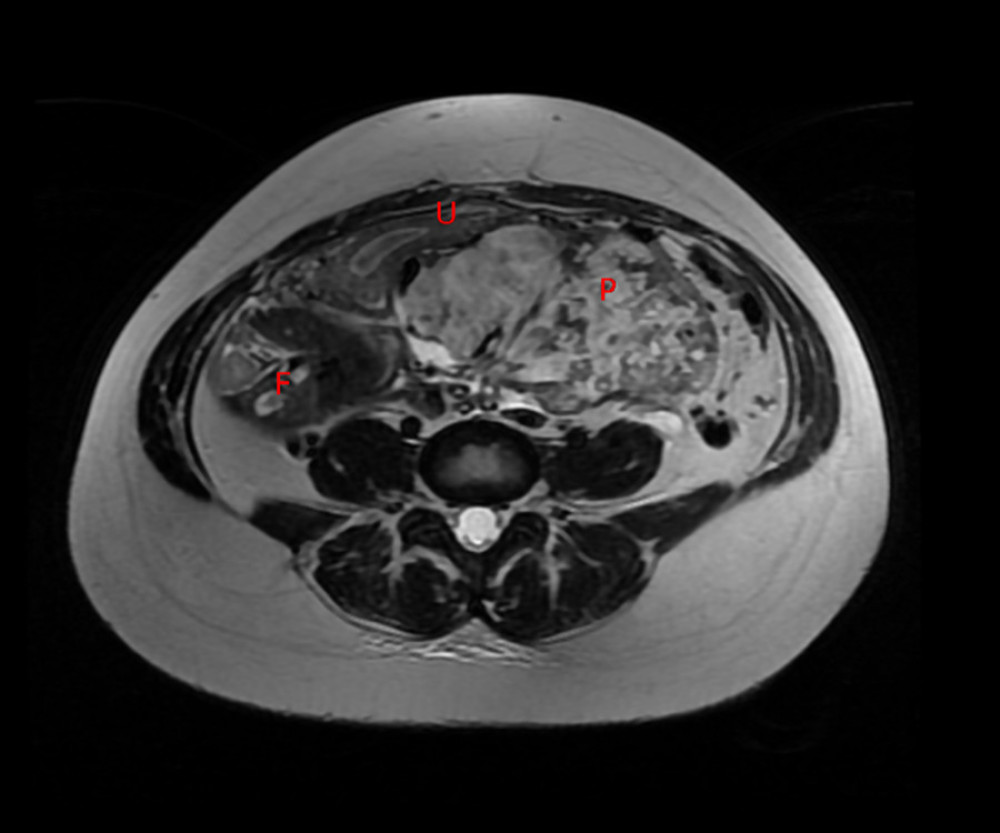 Axial MRI scan section requested for better elucidation of abdominal ectopic pregnancy, in which the following structures are identified and indicated by the letters in red: P – placenta, U – uterus, F – fetus.