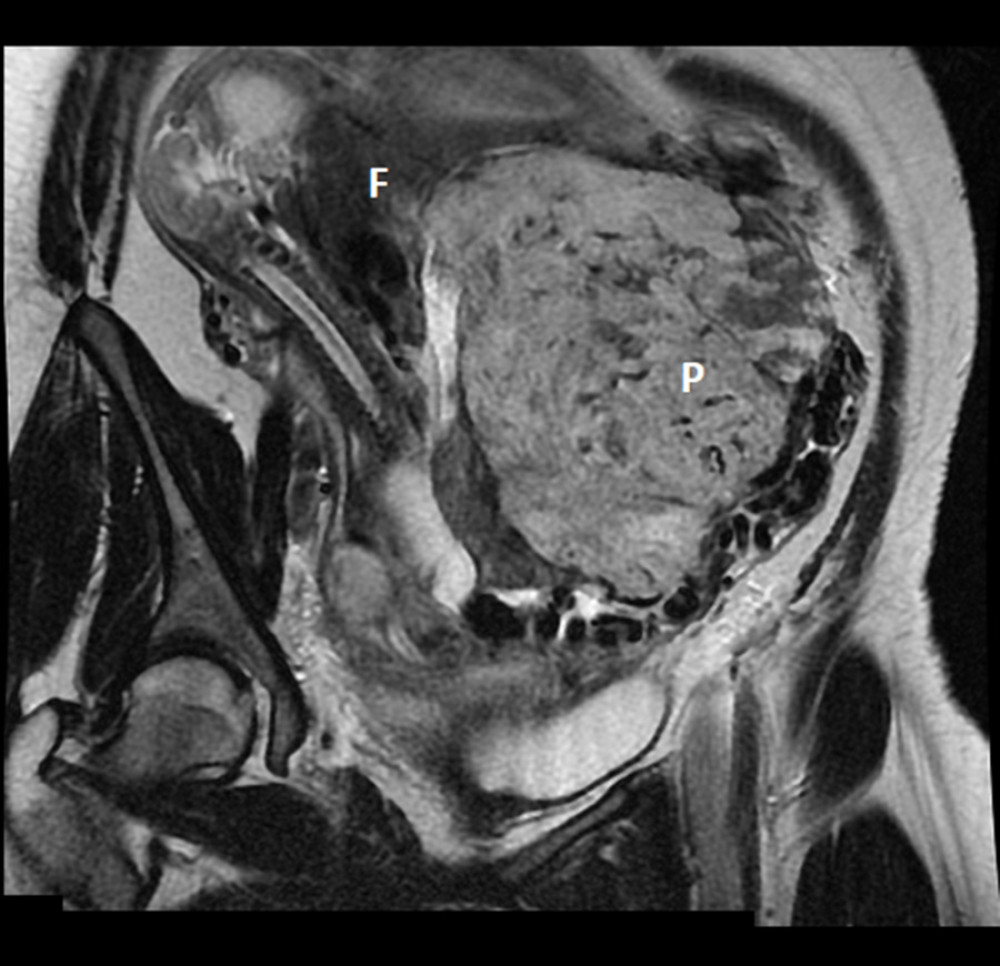 MRI coronal section requested for better elucidation of abdominal ectopic pregnancy, in which the following structures are identified and indicated by the letters in white: P – placenta, F – fetus.