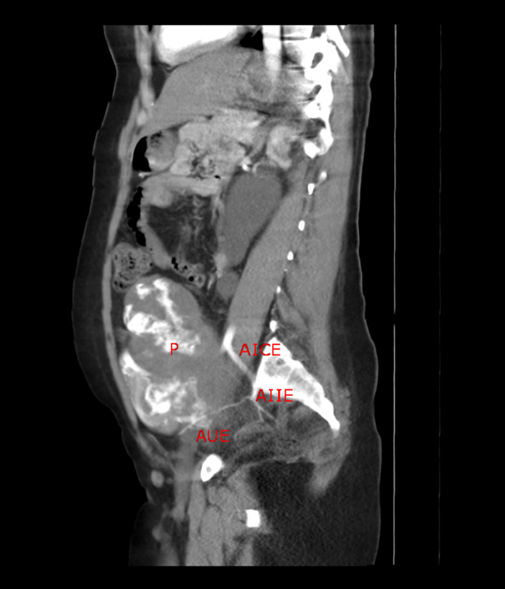 Sagittal section of contrast-enhanced CT angiography performed to check for the possibility of vessel invasion by the placenta. In the image we have the following structures identified by the abbreviationsin red: P – placenta, AICE – left common iliac artery, AIIE – internal iliac artery, AUE – left uterine artery.