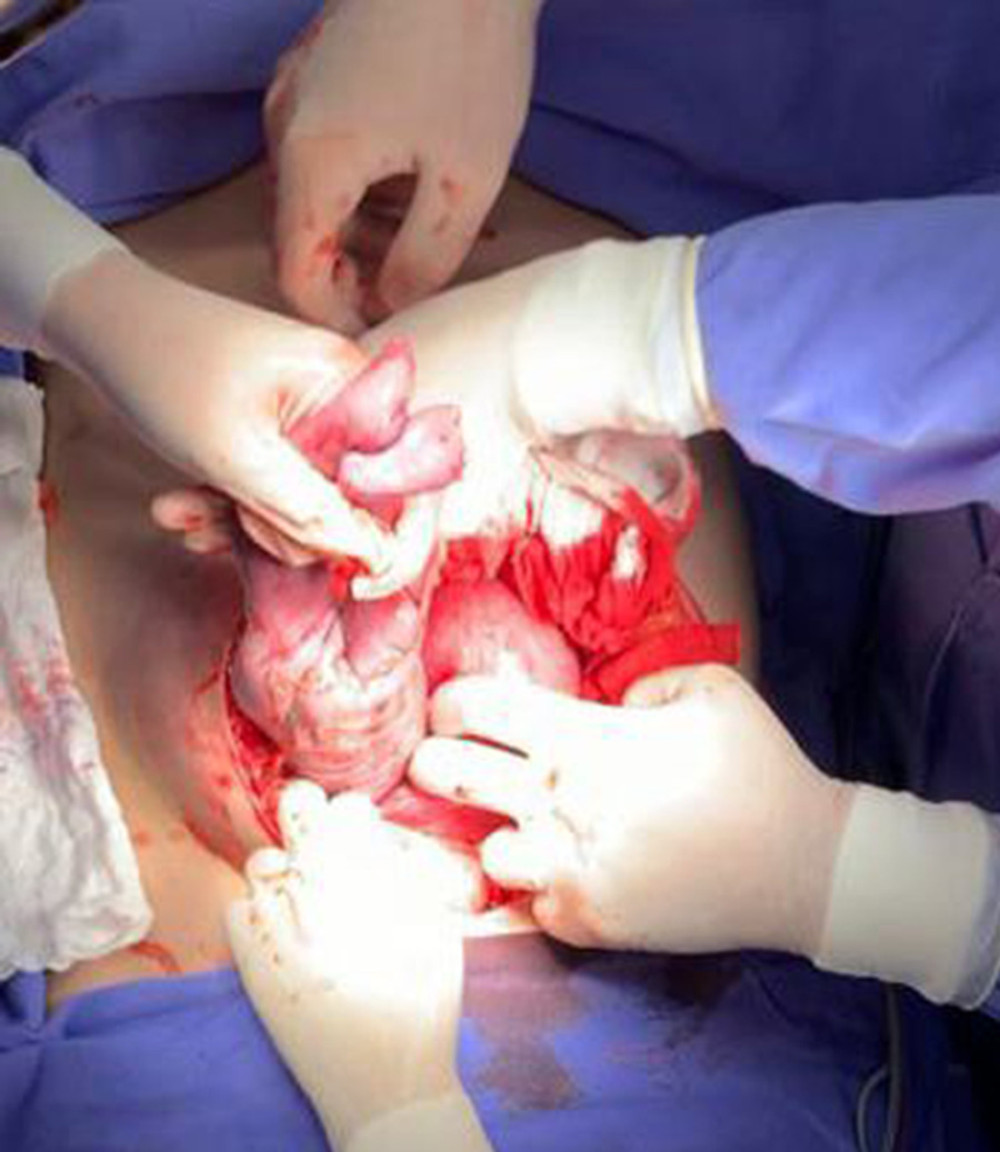 Beginning of fetal extraction from the abdominal cavity. As identified in the photograph, the fetus is marked by the letter F, and the uterus by the letter U. As observed in the picture, the fetus was located posteriorly to the uterus and in pelvic presentation.