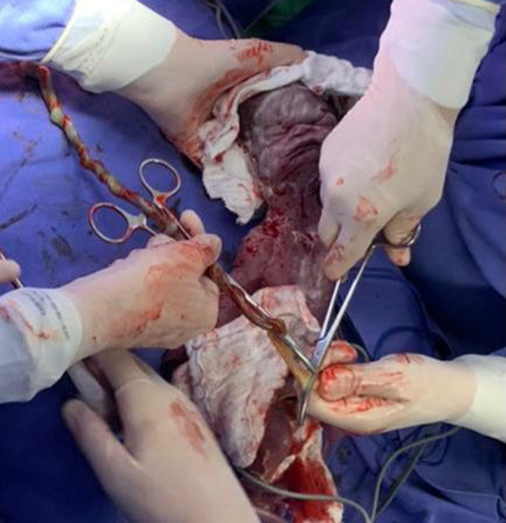 Photo taken immediately after total removal of the fetus from the abdominal cavity, and identified by the letter F. At the moment of the photo immediate clamping of the umbilical cord is performed, indicated by the letter U.