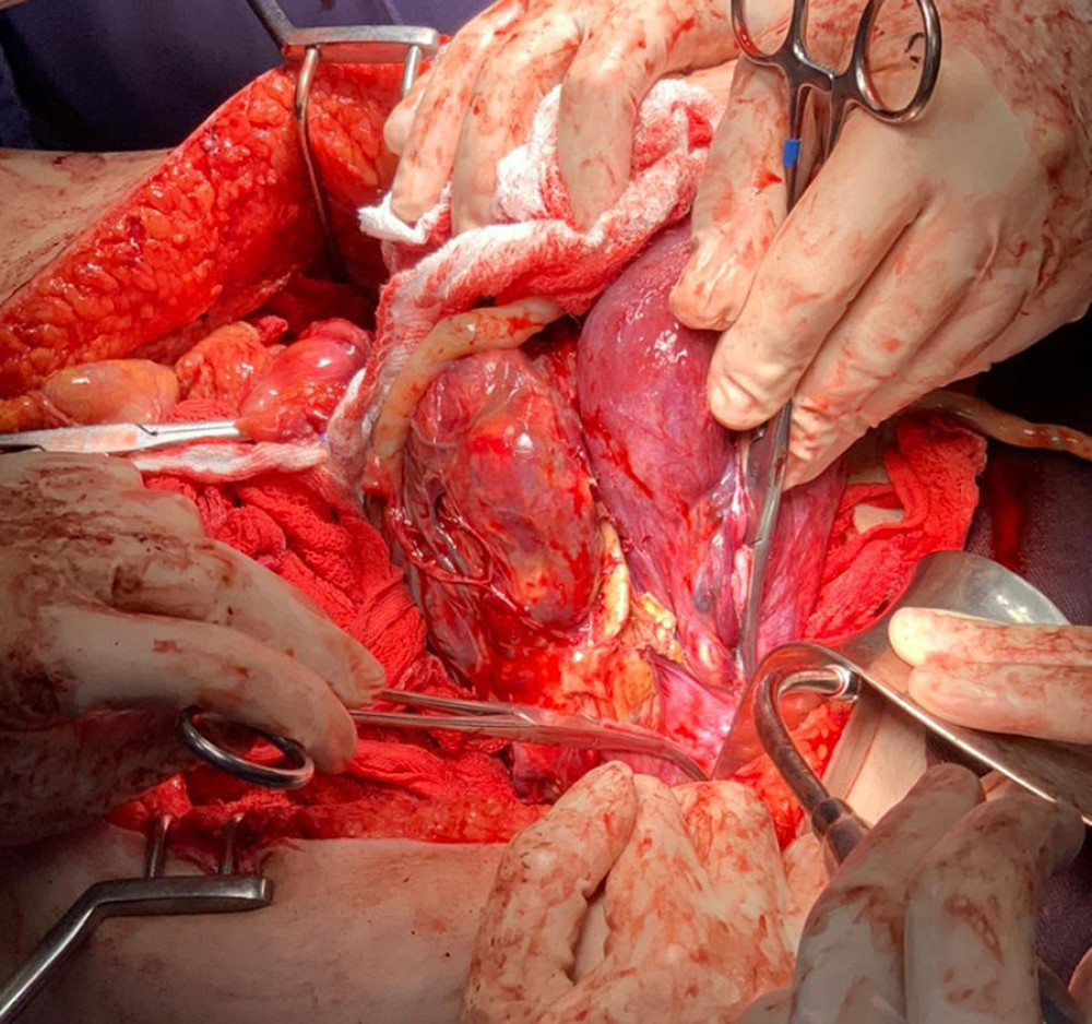 Image taken during a hysterectomy procedure due to heavy abdominal bleeding caused by placental abruption that started soon after the removal of the fetus. In this picture we can clearly identify the placental position in relation to the uterus, being the placenta, identified by the letter P, adhered to the posterior wall of the uterus, identified by the letter U.