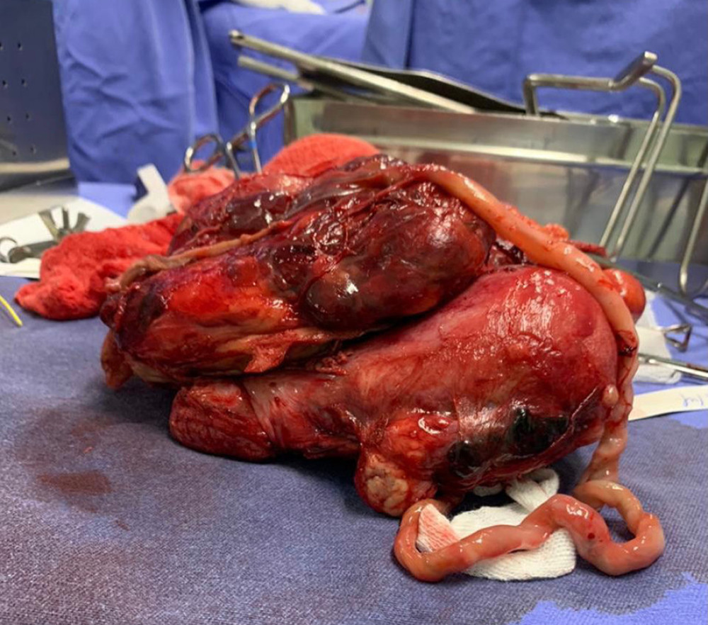 After the end of the surgery, specimen removed from the patient’s cavity. In this picture it is possible to identify the placenta, identified by the letter P, attached to the uterine posterior wall (U).