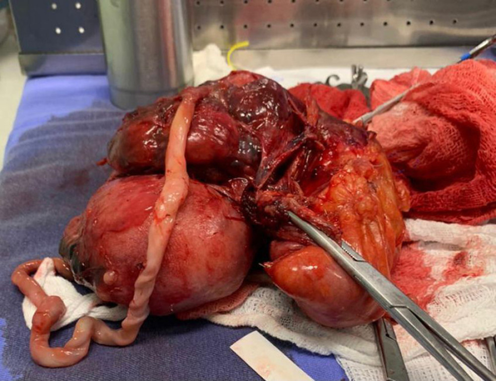 After the end of the surgery, specimen removed from the patient’s cavity. In this picture it is possible to identify the placenta, identified by the letter P, adhered to the uterine posterior wall (U) and part of the sigmoid (S) removed due to invasion by placental mass.