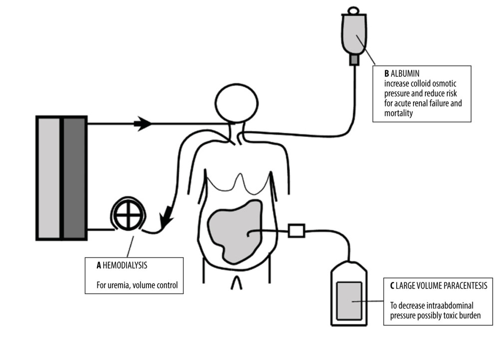 Interventions associated with favorable outcome in a woman with cardiorenal syndrome, ascites, and spontaneous bacterial peritonitis due to Listeria monocytogenes. A) Hemodialysis to control uremia, normalize volume, and maintain normal electrolyte balance. B) Albumin infusion along with proper antibiotic therapy to reduce the severity of renal impairment and mortality and improve intravascular colloid osmotic pressure. C) Large-volume paracentesis to diagnose the causative agent and to decrease the intraabdominal pressure and possibly the toxic burden.