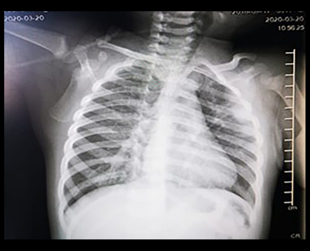 chest X-ray imaging of case 1, showing lung thickening in the left superior lung field and a significant lung texture reinforcement, with hyper-insufflation of lung fields.