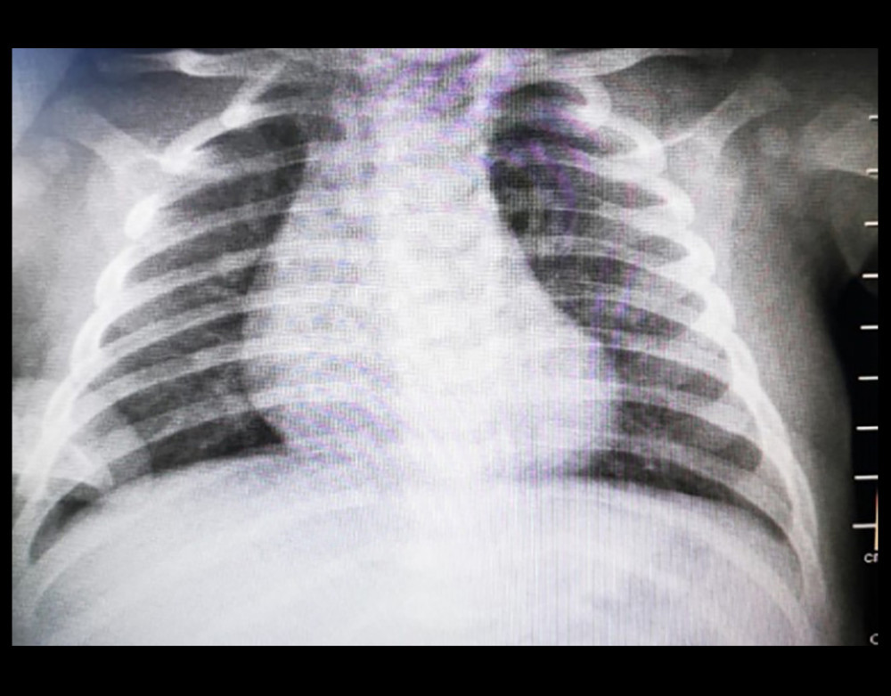Chest X-ray imaging of case 2, showing a normal radiographic picture.
