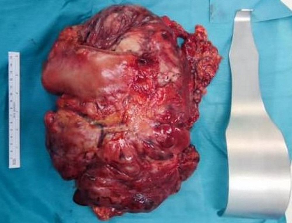 Distal gastrectomy and segmental transverse colon specimen, weighing 3.67 kg, and the measurement is compared to the Deaver retractor.