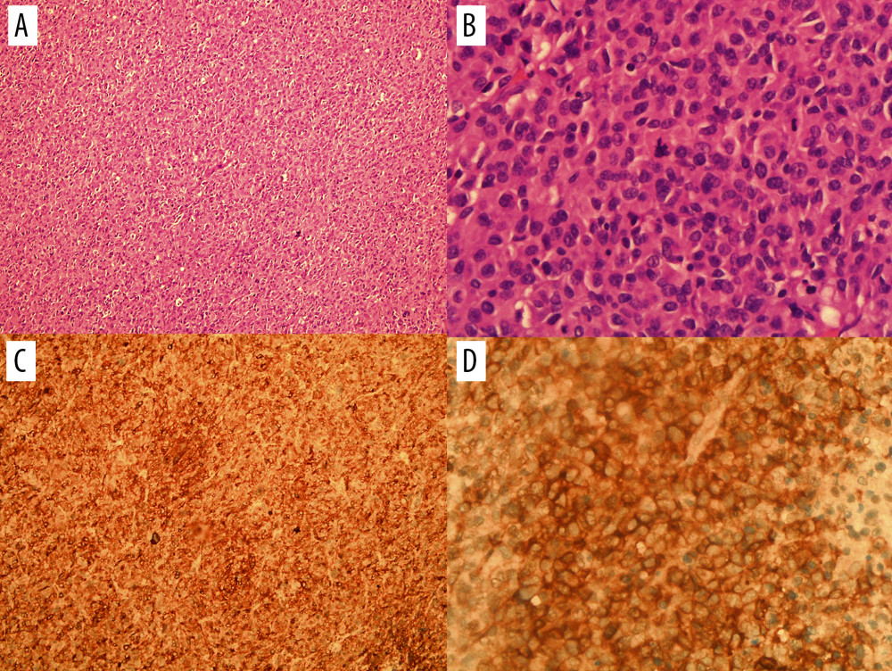The histology at (A) ×10 and (B) ×40 magnification demonstrated neoplastic cells showing round to oval, vesicular nuclei, variably prominent nucleoli, and eosinophilic cytoplasm with ill-defined cell borders. Scattered, bizarre-looking, and multinucleated giant tumor cells are also noted in the specimen with focal myxoid change and tumor necrosis. (B) There are aberrant forms of mitosis, >10 per 5 mm2. Positive immunohistochemistry staining of CD117 at (C) ×10 and (D) ×40 magnification.