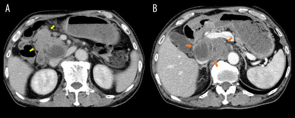 (A) Two up to 3.3-cm enlarged lymph nodes (yellow arrows) involving gastric regional lymph nodes. (B) A large, 11×6 cm, retroperitoneal tumor (orange arrows). The lesion was unusual in its large size and heterogeneous density compared with an ordinary GC nodal metastasis.