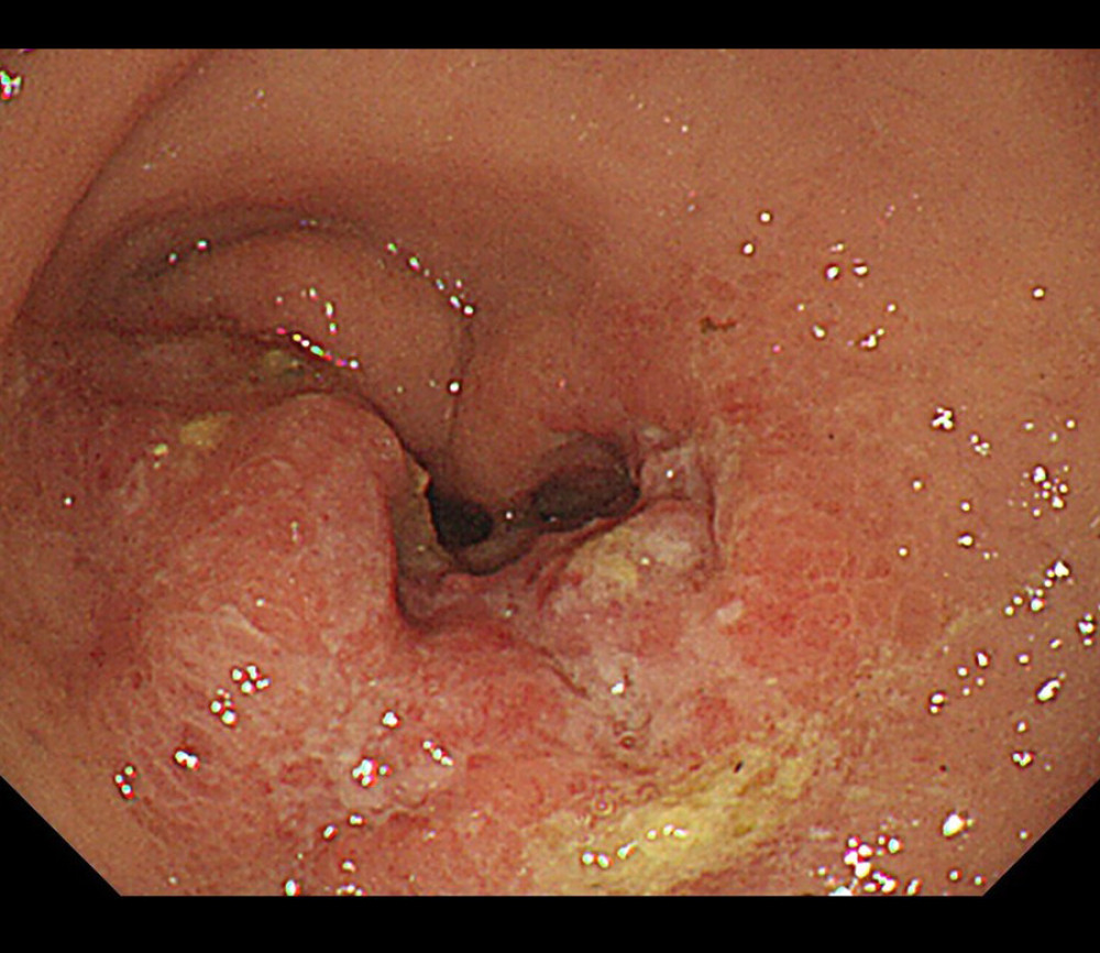 A Borrmann type 3 antral tumor with stenosis of the stomach on gastroscopy.