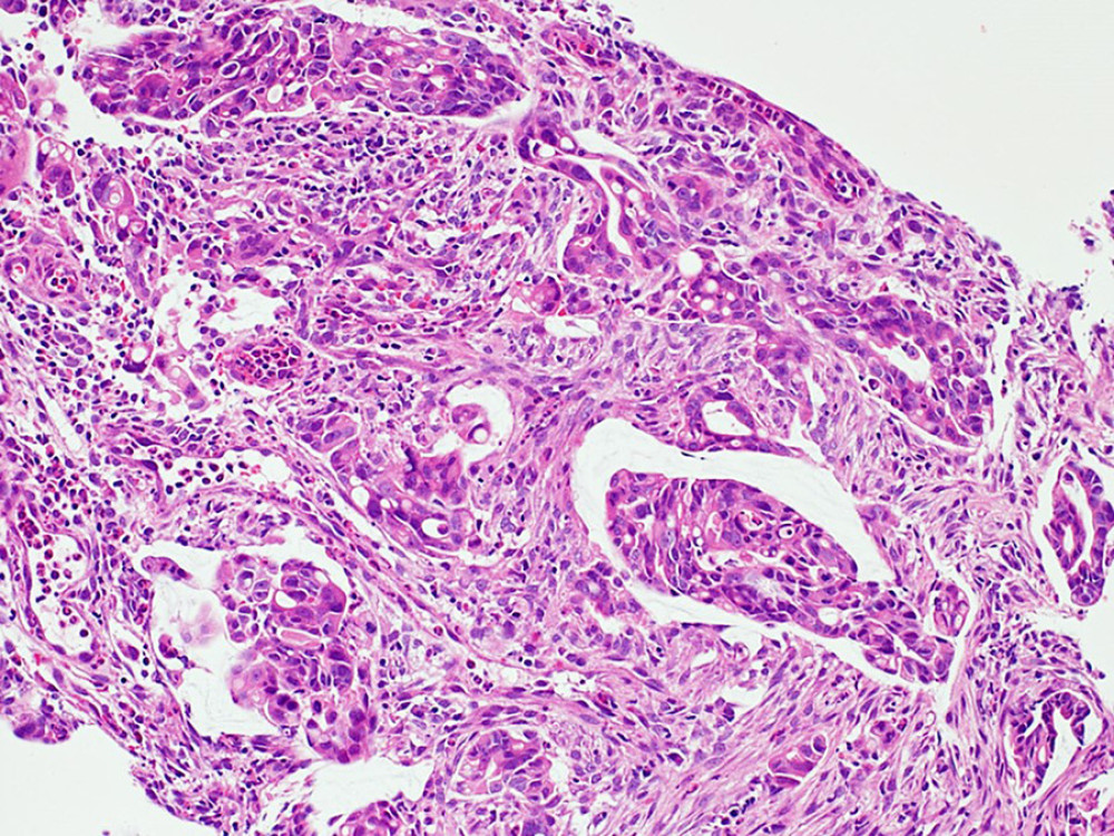 Gastric biopsy revealed a moderately to poorly differentiated invasive adenocarcinoma. H&E original magnification (OM) ×200.