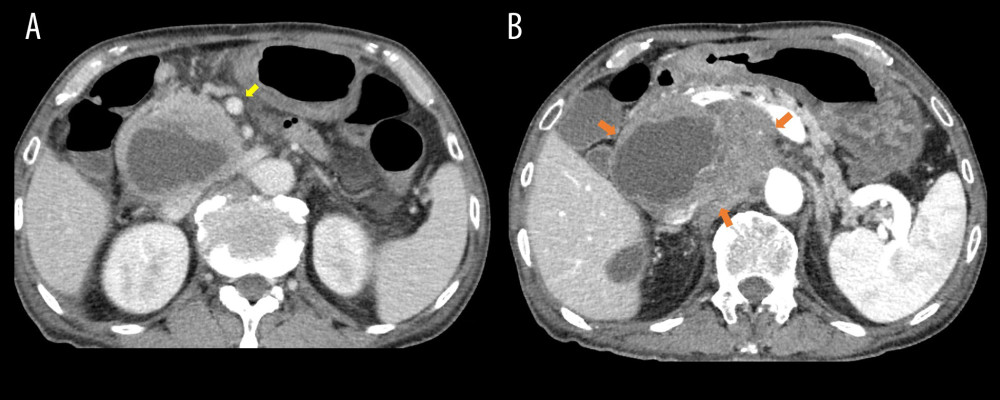 (A) After therapy, the regional lymph nodes decreased in size in comparison with Figure 1a (yellow arrow). (B) The RP tumor rapidly increased in size from 11 cm to 16 cm during therapy (orange arrows).