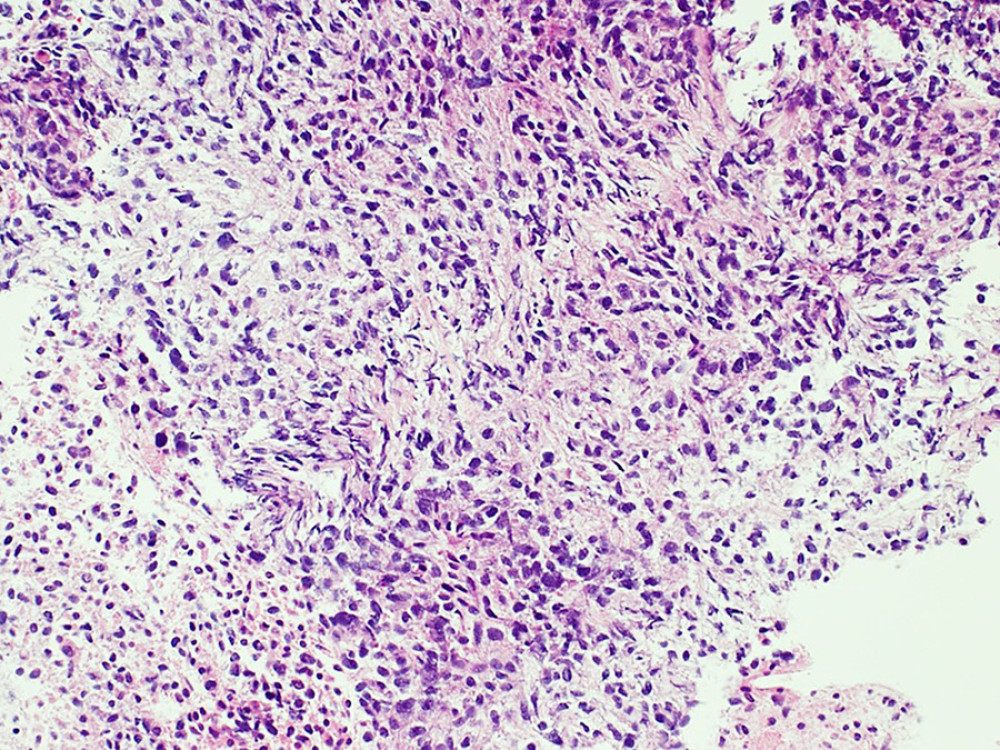EUS-FNA of the RP tumor showed a proliferation of atypical spindle cells arranged in sheets. H&E OM ×200.