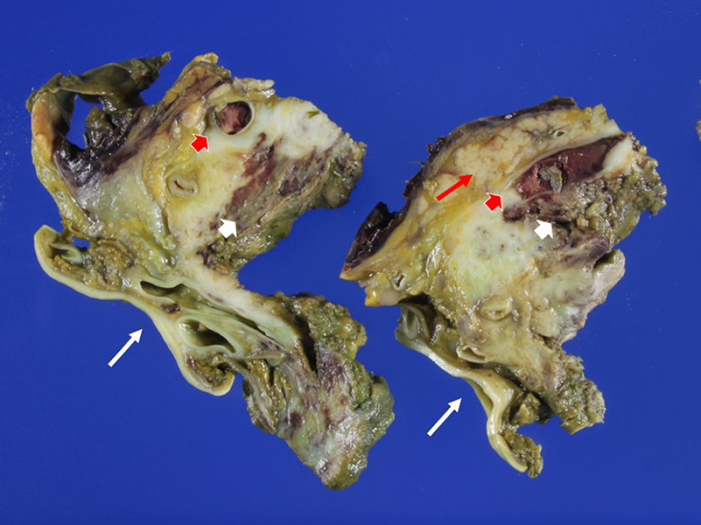 Gross examination at autopsy demonstrated the retroperitoneal tumor near the aorta (white arrows) and pancreas (red arrow) with massive central necrosis (white arrow heads) and invasion into the large vessels (red arrow heads).
