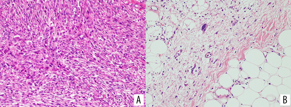 (A) Histology of the retroperitoneal tumor showed a monotonous proliferation of undifferentiated cells with a vaguely storiform pattern. H&E OM ×200. (B) Histology showed that focal areas of the RP tumor had well-differentiated LPS characterized by mature adipocytes and scattered atypical stromal cells. H&E OM ×200.