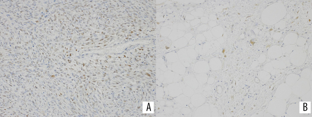 (A) Many tumor cells within the dedifferentiated areas are positive for MDM2. MDM2 OM ×200. (B) Scattered cells are positive for MDM2 in the well-differentiated LPS areas. MDM2 OM ×200.