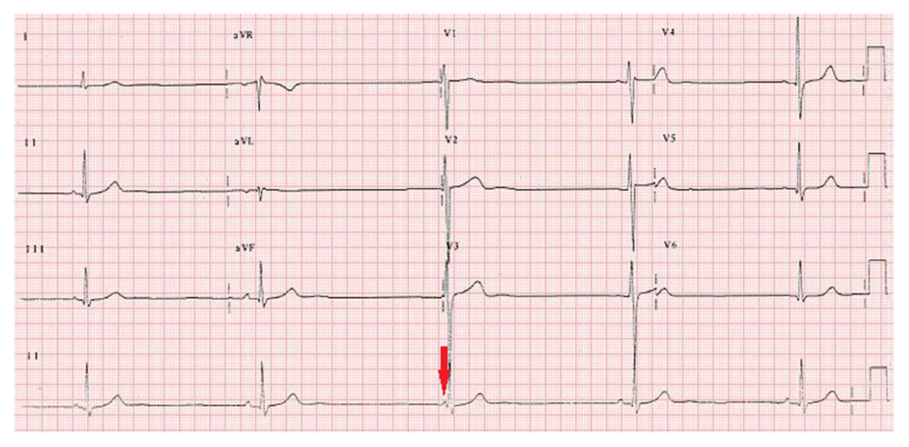Admission ECG showing sinus bradycardia with junctional escape rhythm (red arrow).