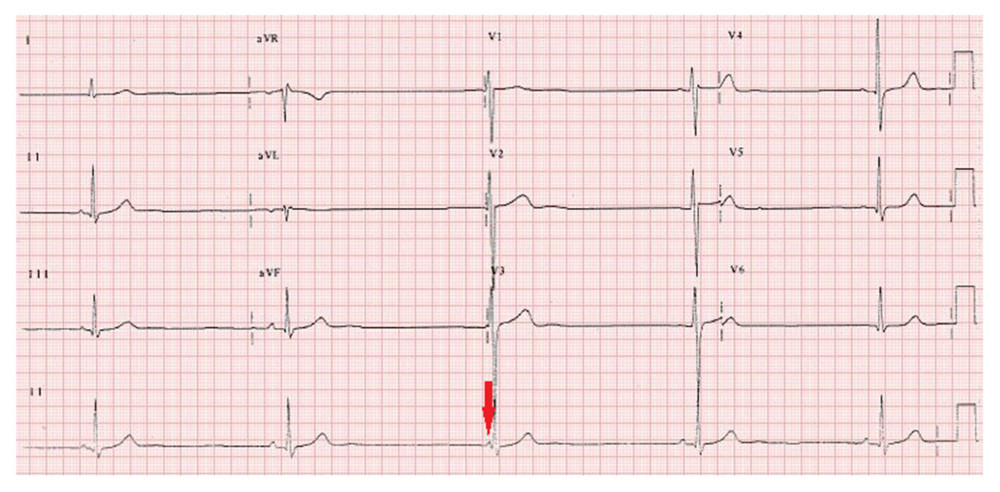 Admission ECG showing sinus bradycardia with junctional escape rhythm (red arrow).