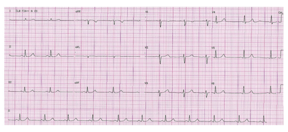 Discharge ECG showing normal sinus rhythm, heart rate of 83 bpm.