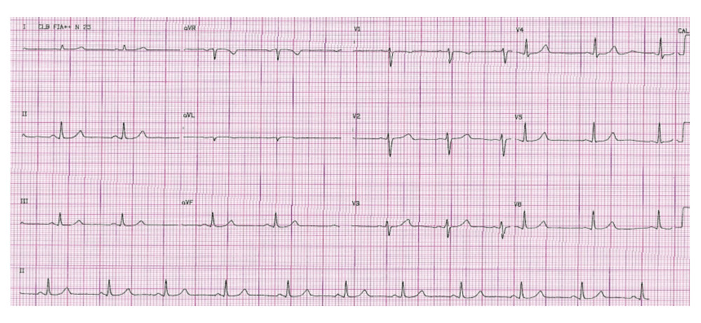 Discharge ECG showing normal sinus rhythm, heart rate of 83 bpm.