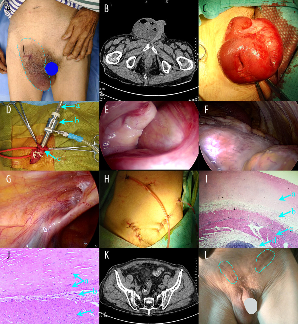 (A) A giant strangulated lump in the right groin within the blue line. (B) The abdominal computer tomography depicted a large lump in the right groin. (C) A mass of small intestine (the terminal ileum) was stuck together. (D) Laparoscopic exploration was performed using hernioscopy. a: lens barrel; b: 10-mm trocar; c: open hernia sac. (E, F) All the bowel and mesentery were almost totally wrapped by a fibrocollagenous and cocoon-like membrane. (G) The left inguinal hernia. (H) Drainage tubes were used to prevent infection. (I, J) Postoperative pathology of the small bowel wall and its fibrous membrane. a: fibrocyte proliferation and collagen fiber enrichment; b: serosal layer; c: muscular layer; d: the submucosa. Hematoxylin-eosin staining. (K) The abdominal computer tomography on the 5th day after operation. (L) Follow-up after 6 months. Bilateral inguinal hernia did not recur.