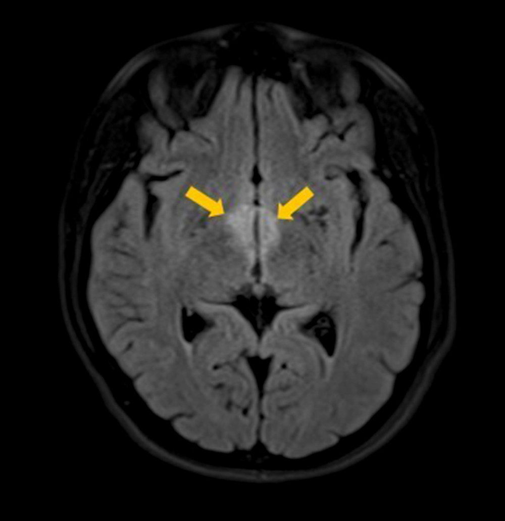 Brain magnetic resonance imaging (MRI) with contrast revealed bilateral, non-enhancing, patchy fluid-attenuated inversion recovery (FLAIR) hyperintensities in anteroinferomedial thalamus extending to the mammillary bodies.