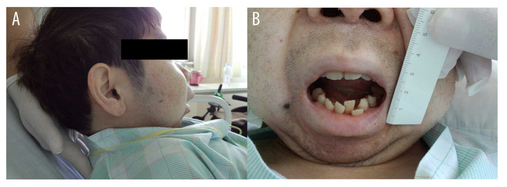 (A, B) The patient’s neck was short and had very limited movement. The maximum mouth opening was 3 cm in interincisional distance.