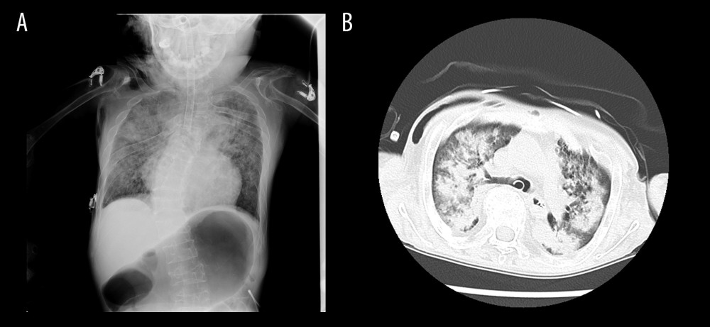 Chest computed tomography scan of a patient with juvenile rheumatoid arthritis after difficult endotracheal intubation. (A) Chest radiograph after intubation showed pulmonary edema in both lobes and no cardiomegaly. (B) Chest computed tomography showed bilateral infiltration and diffuse ground-glass opacities, which were suggestive of pulmonary edema.