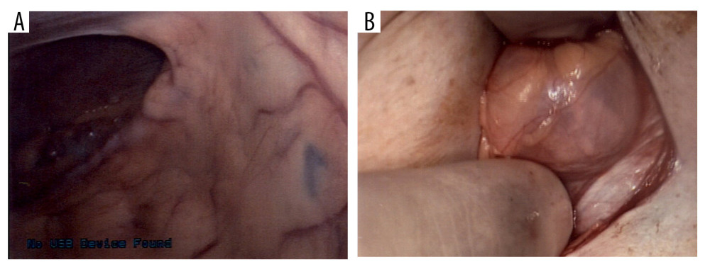 A spigelian hernia from a patient with juvenile rheumatoid arthritis. (A, B) The hernia content was omentum, and the defect size was 2.0×2.0 cm.