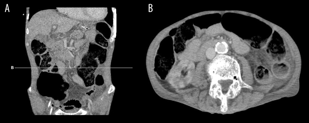 Enhanced whole-body computed tomography (CT) of the colon at admission. (A) Coronal view, demonstrating the dilated and distended ascending colon and descending colon. (B) Axial view, indicating the dilated and distended transverse colon.