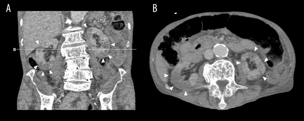 Enhanced whole-body computed tomography (CT) of the kidneys at admission. (A) Coronal view and (B) axial view, demonstrating symmetric normal size kidneys with multiple bilateral wedge-shaped nonenhancing parenchymal regions (arrow heads).