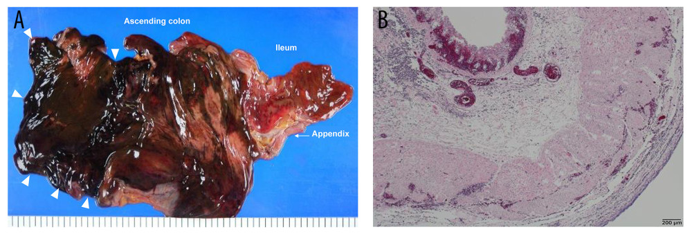 (A) A macroscopic view of the ileocecal area showing discontinuously dark red (arrowheads) ascending and transverse colon. Compared with the colon, the color of the small intestine was preserved. (B) Histological examination of the colon in hematoxylin and eosin stain at 100-fold magnification, showing bleeding, congestion, infiltration of neutrophils, and empty epithelial cysts.