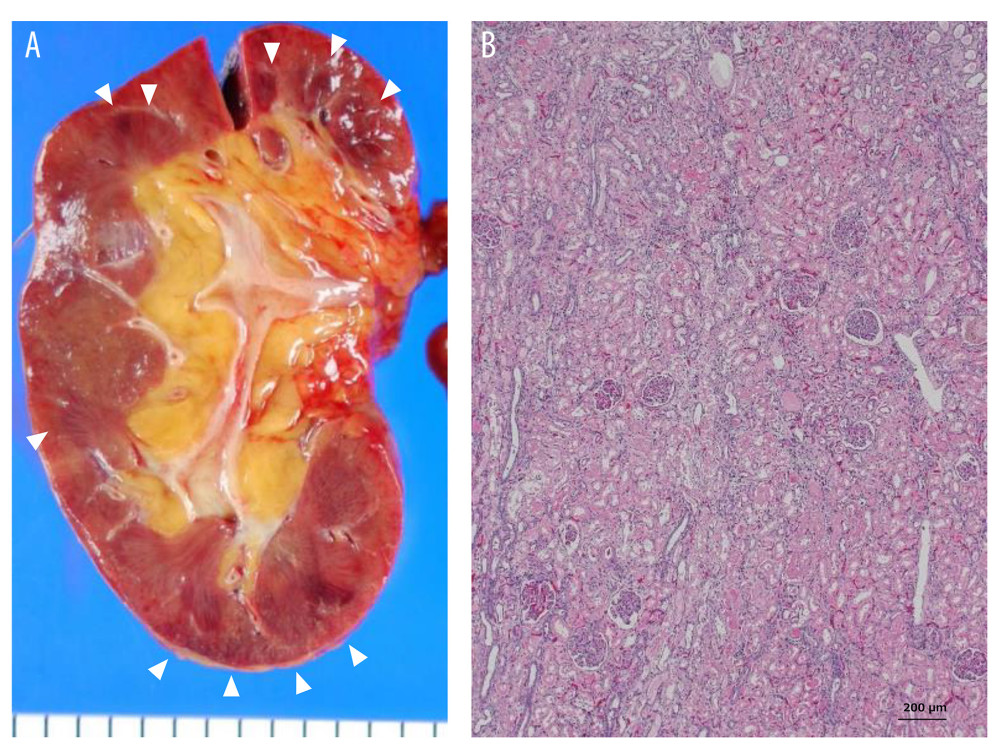 (A) A macroscopic cross-section of the right kidney showing patchy color, indicating hemostasis and ischemia (arrowheads). (B) Histological examination of the kidneys in hematoxylin and eosin stain at 100-fold magnification, showing acute renal tubular necrosis, but relatively unaffected glomeruli with no invasion of microorganisms.