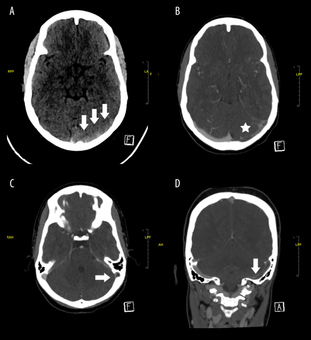 Non-contrast cerebral CT scan (A) showing hyperdense sinus sign in the left transverse sinus (3 arrows). CT-venogram (B–D) showing filling defect in the left transverse sinus (B, axial view, Star) and left sigmoid sinus (C, axial view, vertical arrow; D, coronal view, horizontal arrow), findings compatible with extensive thrombosis in left transverse and sigmoid sinus.