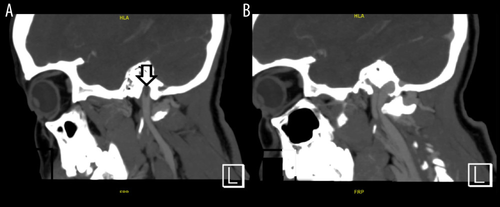 CT-venogram sagittal view (A) showing filling defect in the proximal segment of left internal jugular vein owing to thrombus extension. (B) normal filling of internal jugular vein on the right side.