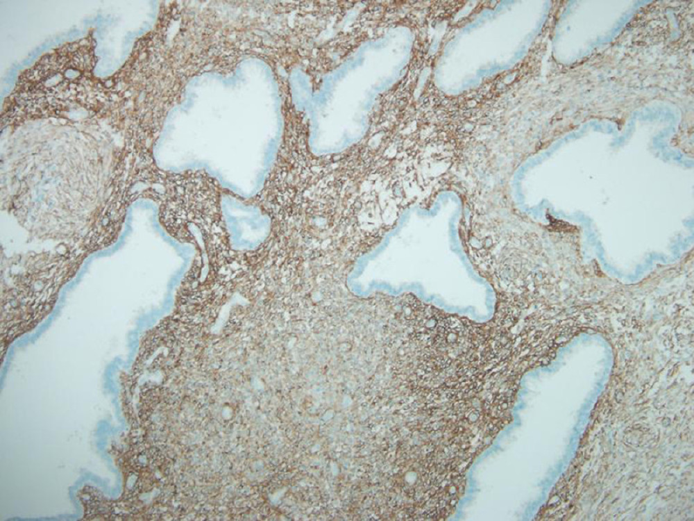 Light microscopy photograph of CD10 immunohistochemistry staining study showing cell membrane positivity for stromal cells (CD10 immunohistochemistry stain, ×100).