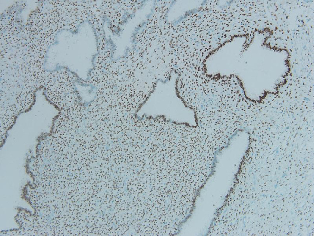 Light microscopy photograph of ER immunohistochemistry staining study showing nuclear positivity for stromal cells (ER immunohistochemistry stain, ×100).