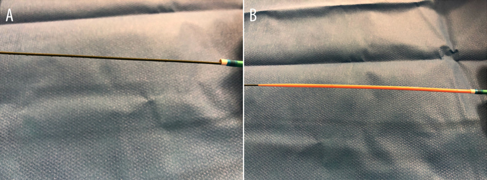 (A) Sharp edge at guide catheter tip works like a “razor blade”.(B) Smooth tapering from RSS dilatator and guiding catheter for navigating difficult anatomies.