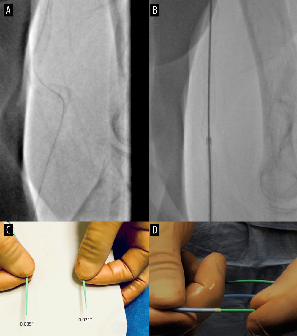 (A) Tortuosity and severe calcification of brachial artery. Difficult crossing with 0.035-inch Terumo guidewire. (B) Successful crossing with the Railway Sheathless Access System. (C) Two sheathes introducer catheters compatible with 0.035-inch or 0.018-inch guide wire. (D) The insertion in the guiding catheter by pushing the back end of the introducer.