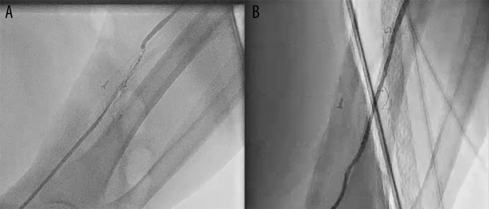 (A) Thrombotic occlusion of the proximal radial artery after the first PCI procedure. (B) Complete recanalization of the radial artery after crossing with the 7Fr guiding catheter.