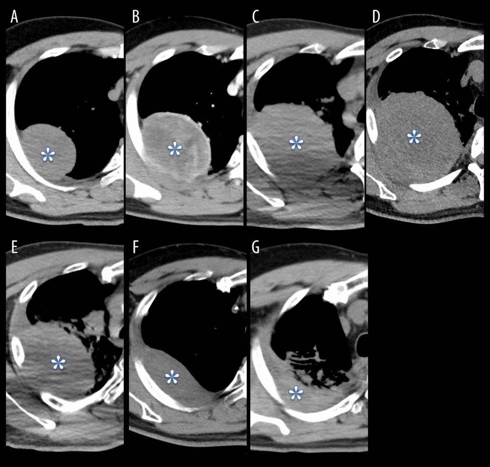 CT axial images before and during the treatment. A (Day −37), B (Day −18), C (Day −4), D (Day 11), E (Day 29), F (Day 51), G (Day 282). A, B, images before treatment; C–F, images during chemoradiotherapy; G: follow-up CT image taken during durvalumab maintenance. The asterisk indicates a primary tumor.