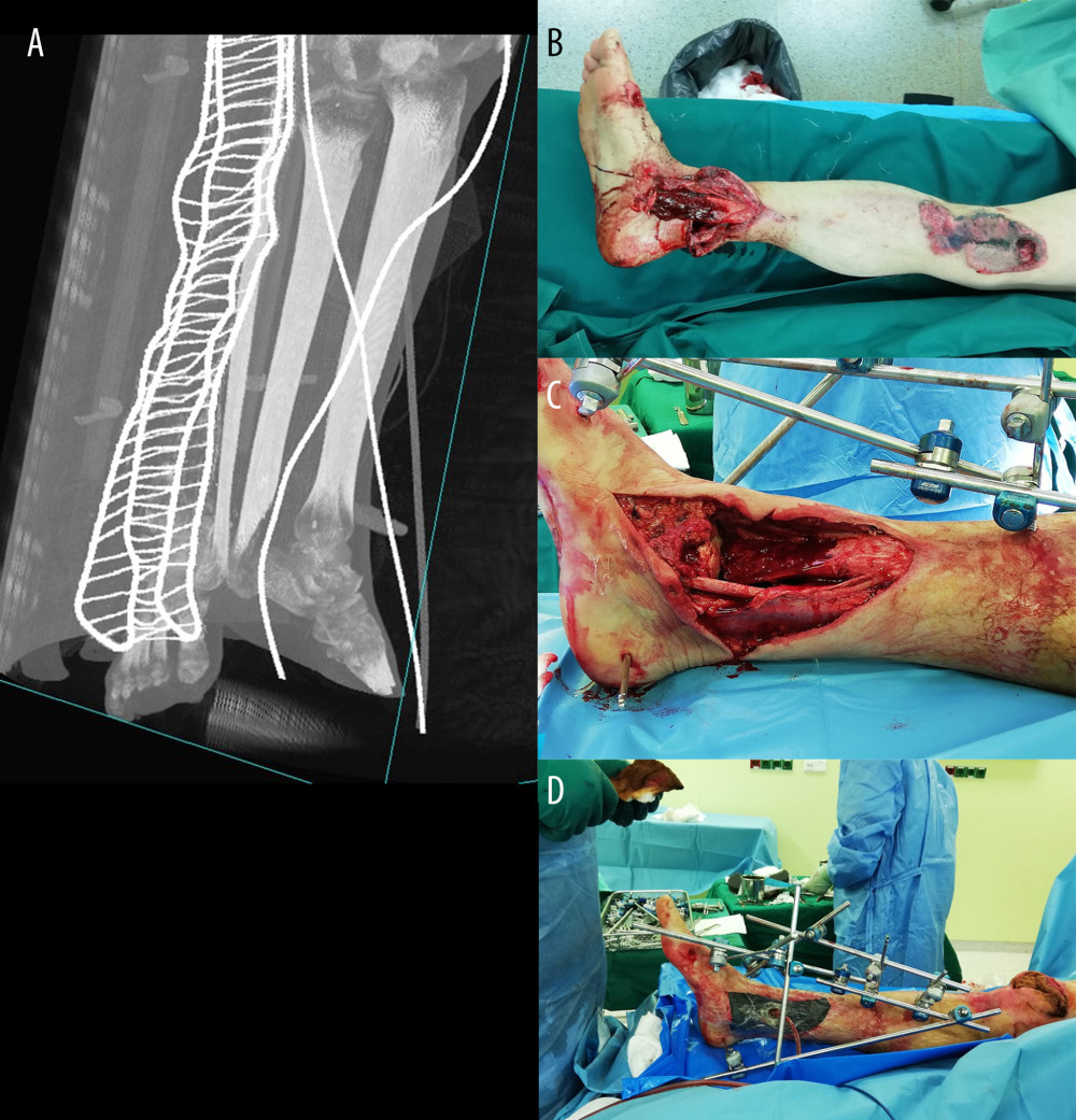 (A) Computed tomography scan (preoperative) of the 52-year-old man showing Gustilo-Anderson III B open distal third tibial fracture. (B) Clinical photograph (preoperative) presenting the damaged limb with severe soft-tissue defect. (C) Clinical photograph showing extensive soft-tissue and bone defect after wound revision and debridement. (D) Clinical photograph (postoperative) presenting the fracture stabilization using monolateral external fixation apparatus and the vacuum-assisted closure system for wound coverage.