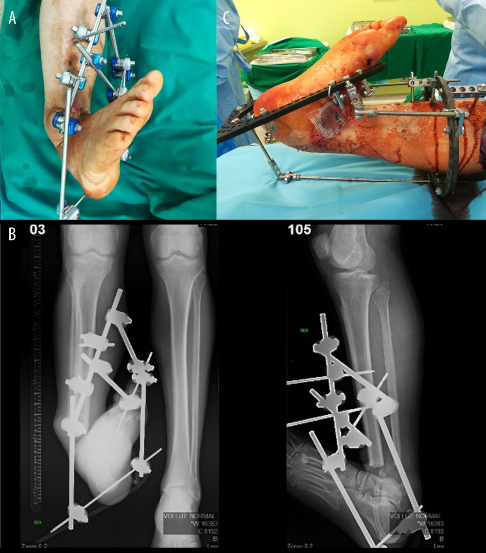 (A) Clinical photograph showing the wound closure of the damaged limb by artificial deformity-creating including shortening, translation, angulation, and rotation. (B) X-ray (anteroposterior and lateral) showing the damaged limb after artificial deformity-creation was performed. (C) Clinical photograph presenting the residual skin defect closure using auto-dermoplasty.